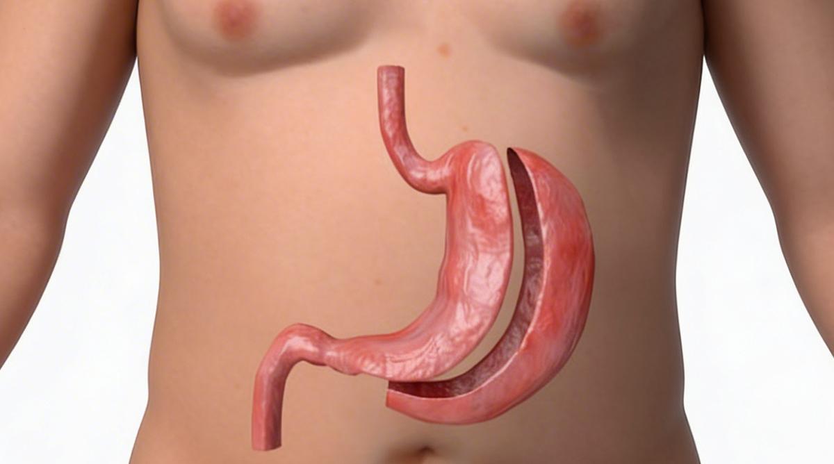 Gastroplastia: O Que É e Como Funciona