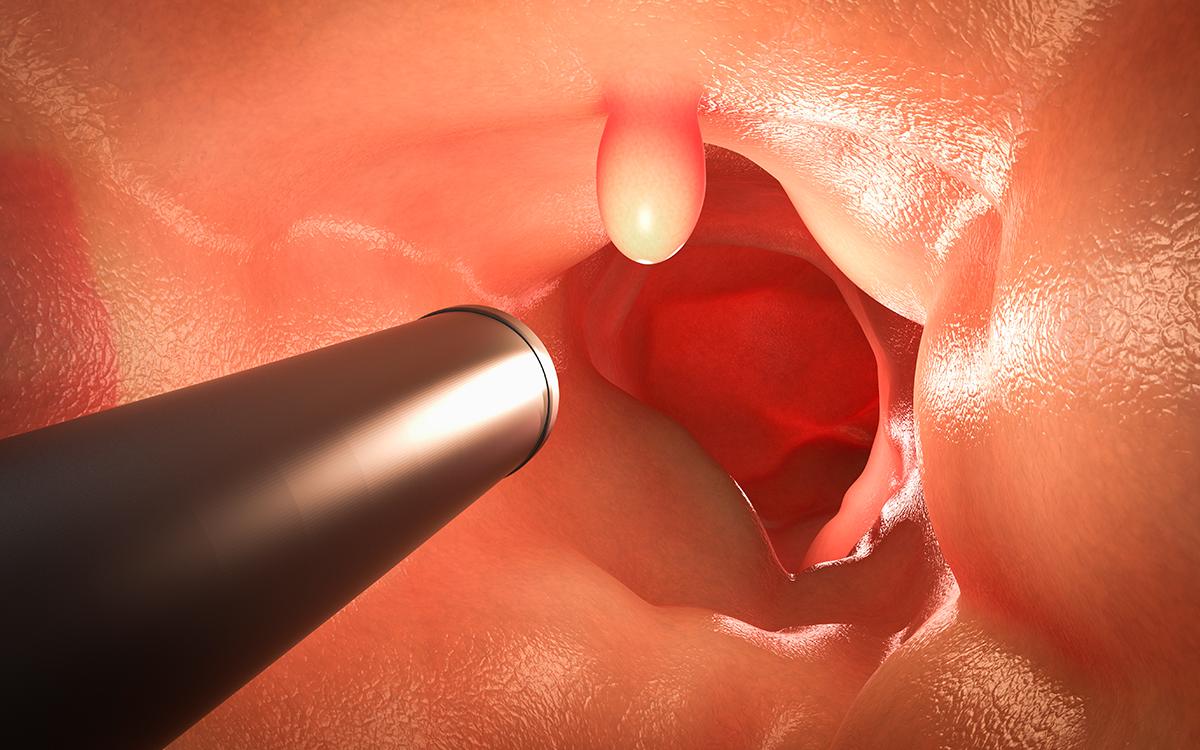 Pólipos no intestino são perigosos?