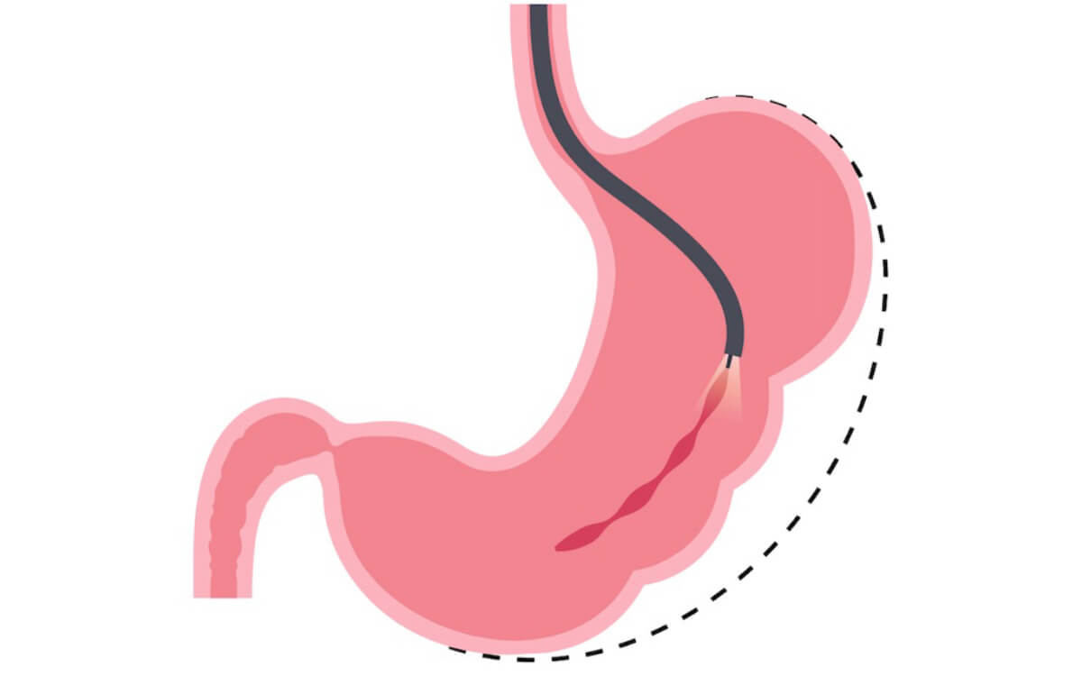 Grastroplastia endoscópia: como é feita. Médico especialista em gastroplastia em Brasília DF.